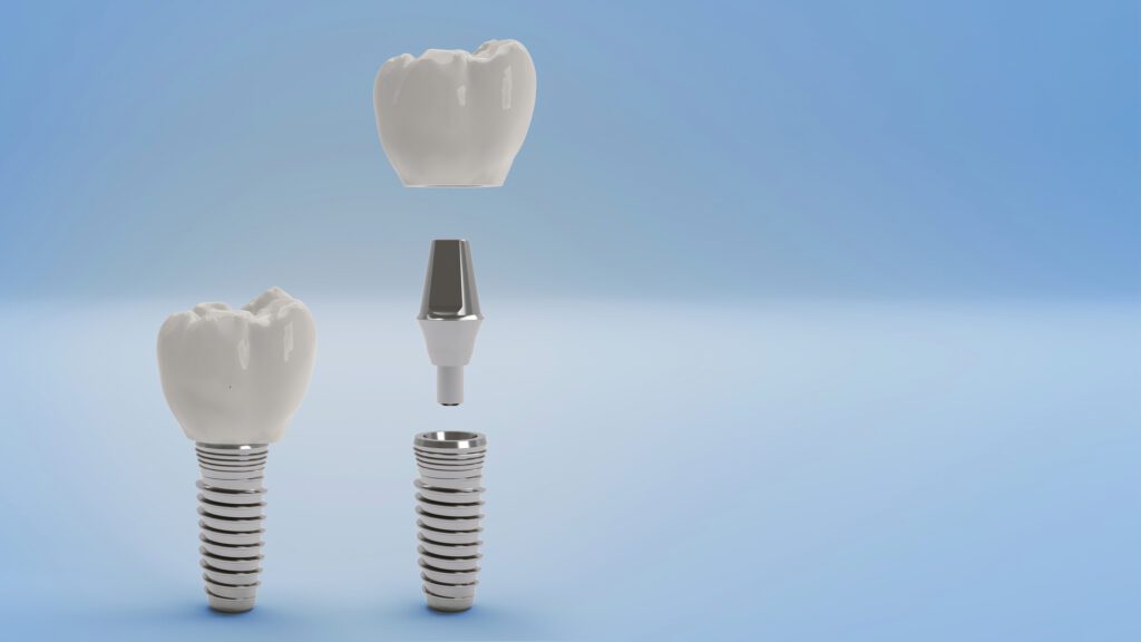 Dental Implants in Raleigh, North Carolina