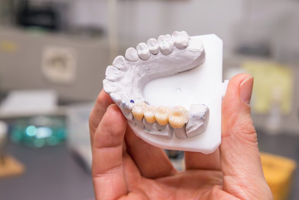 Dental Bridge for Multiple Missing Teeth in Raleigh, North Carolina