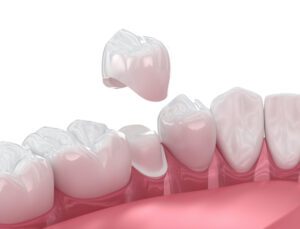 Do I Really Need a Dental Crown? in Raleigh, NC