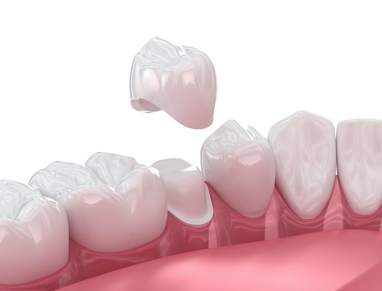 A dental crown could help restore the strength, functionality, and appearance to damaged or weakened teeth.